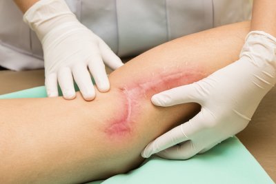 Scars Compensation in Glen Burnie, MD